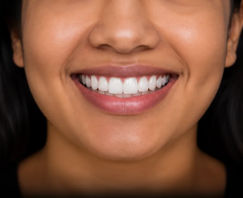 Smile after professional whitening at Dental Spot