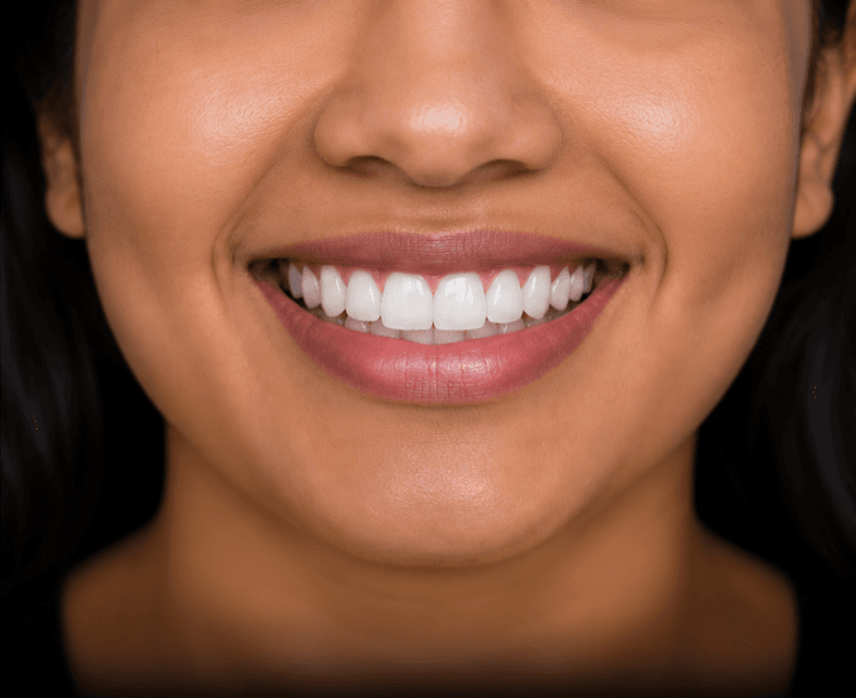 Smile after professional whitening at Dental Spot
